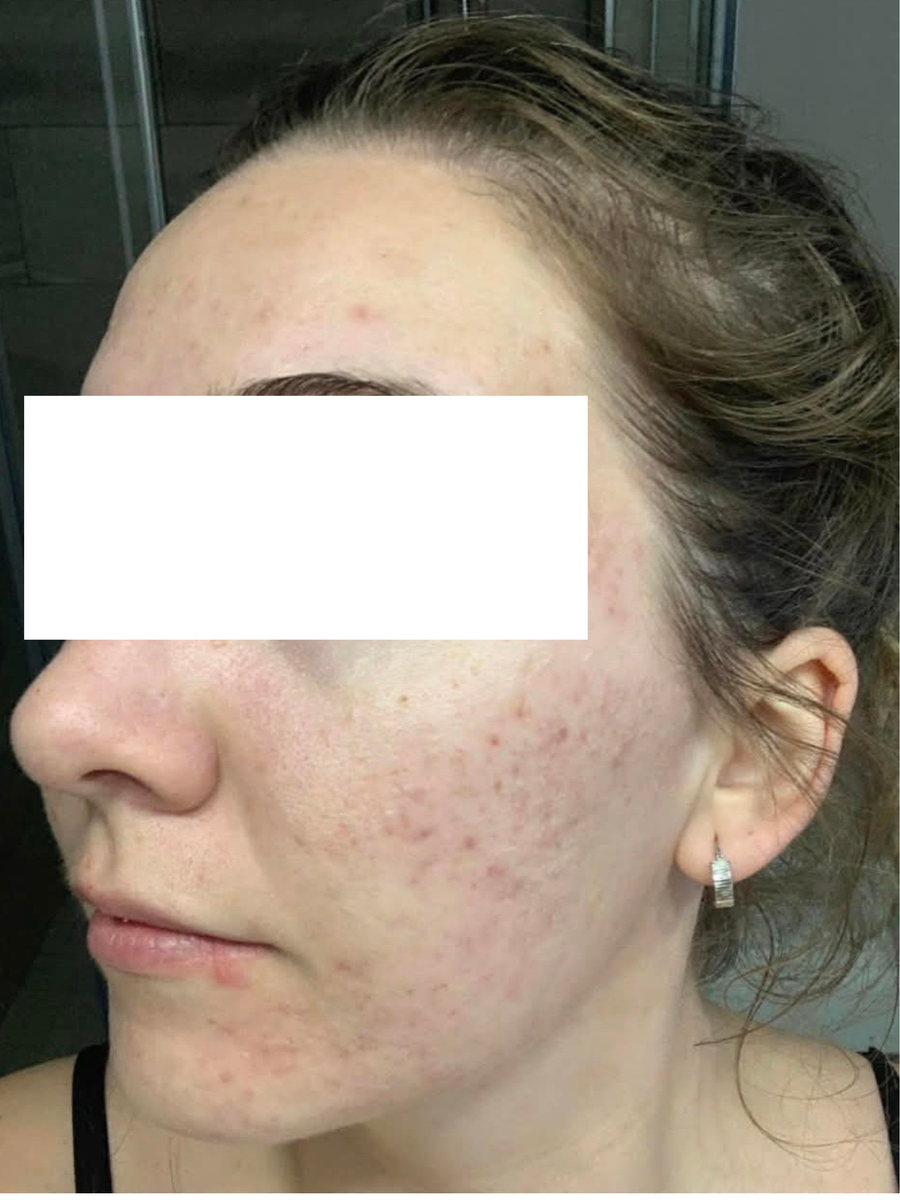 Before treatment