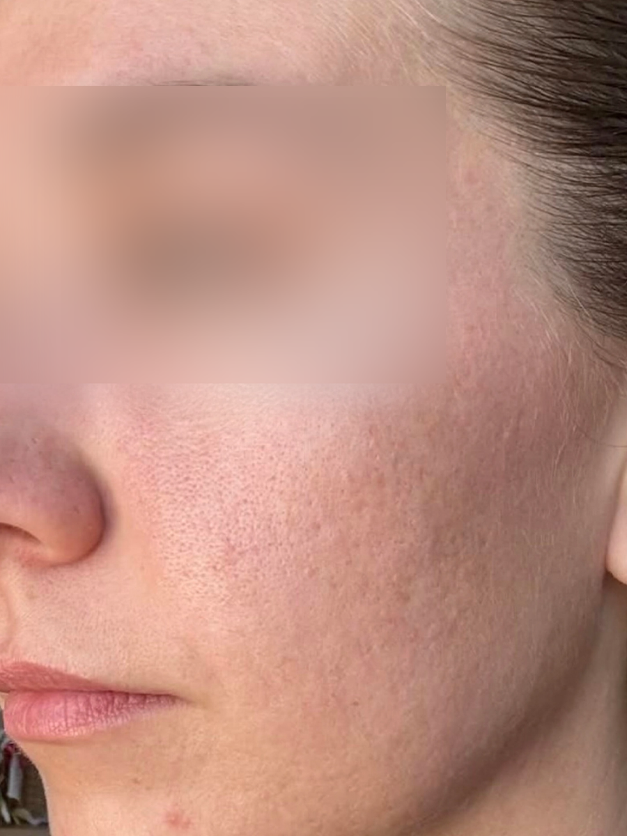 After treatment