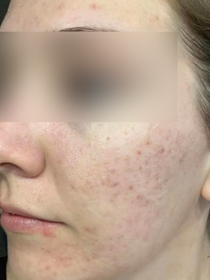 Before treatment