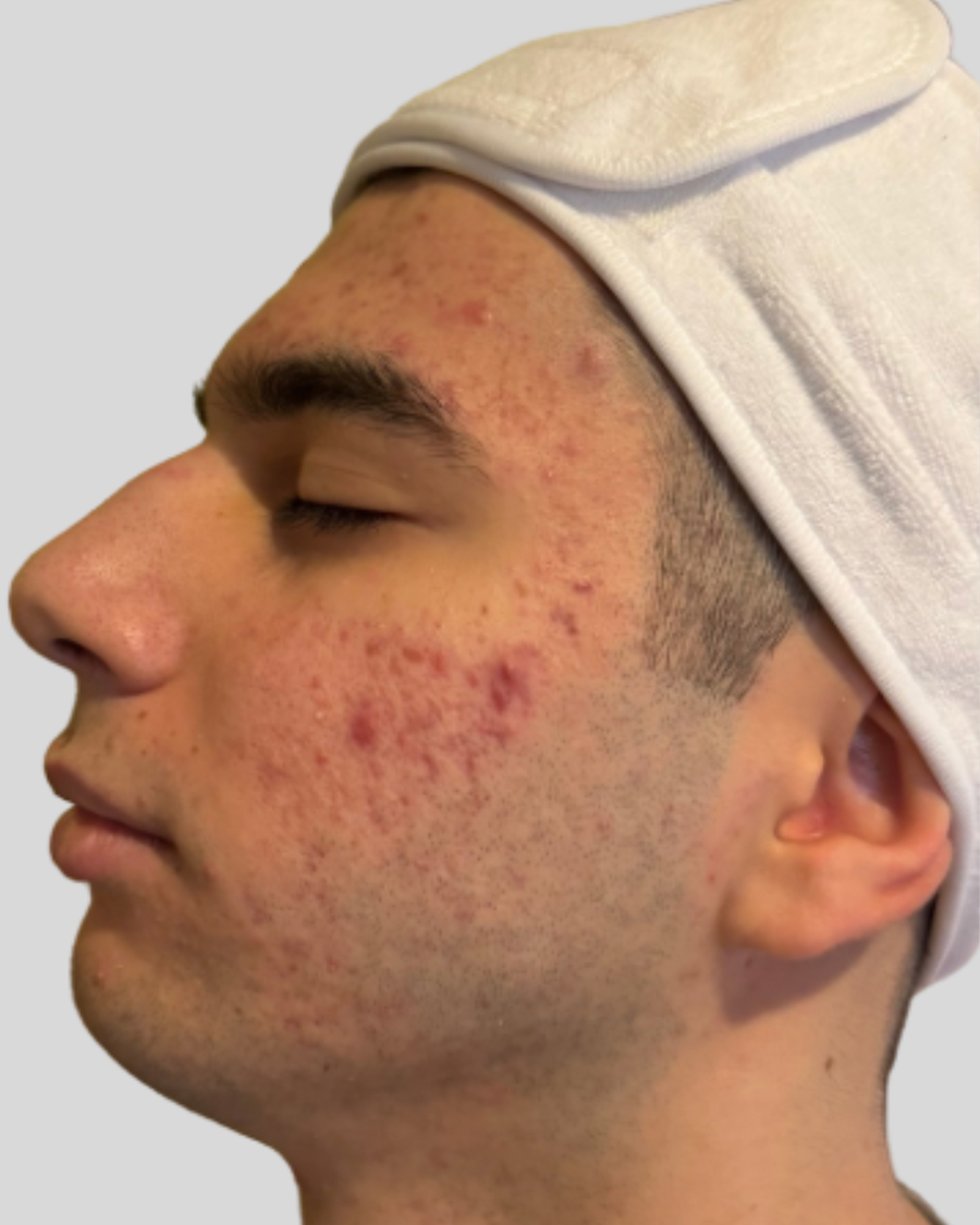 Before treatment